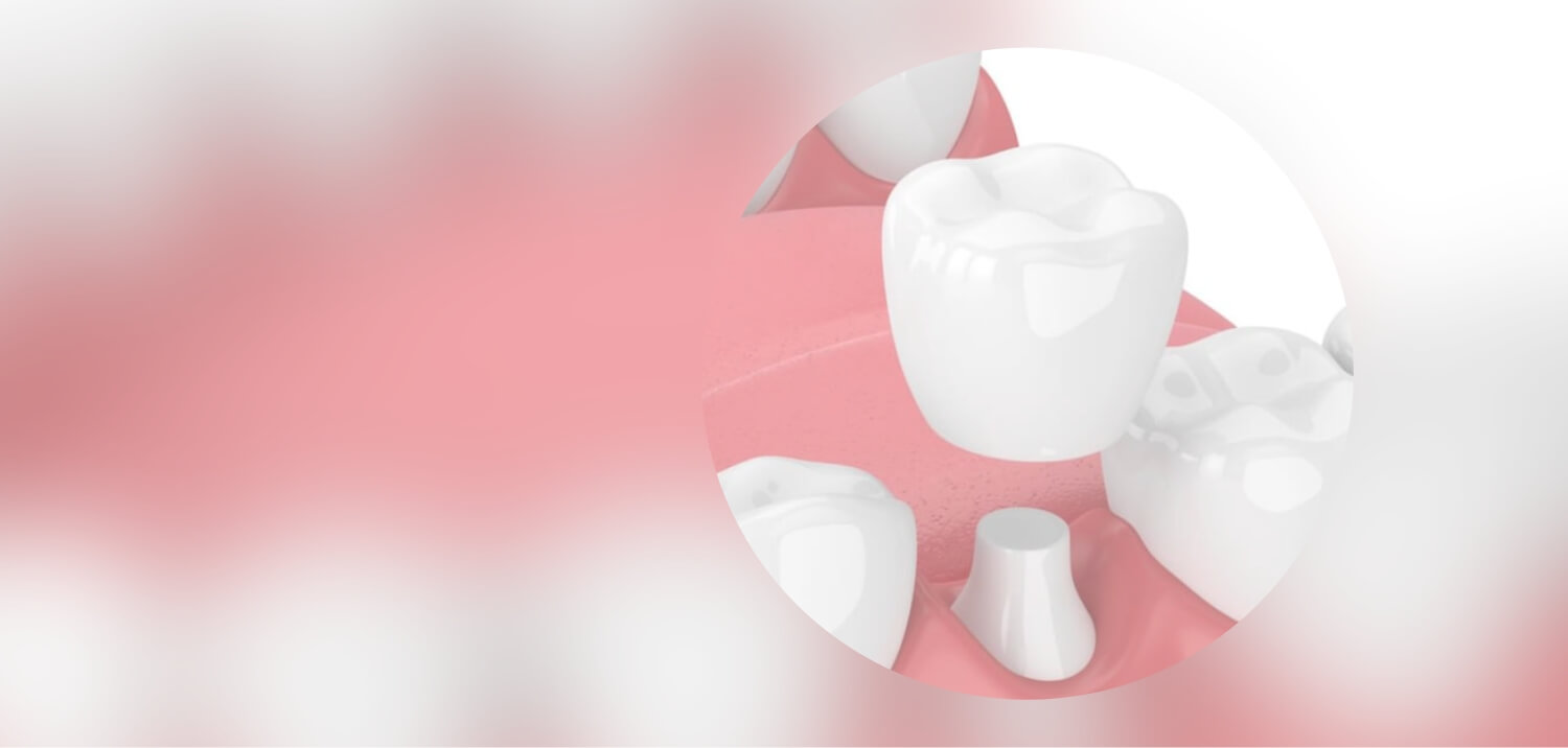 歯を白くする治療（セラミック治療）