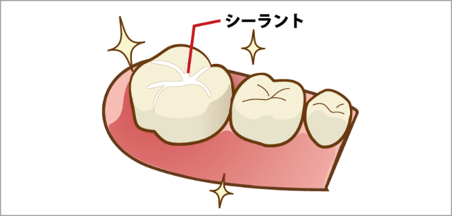 虫歯になりやすい奥歯を保護