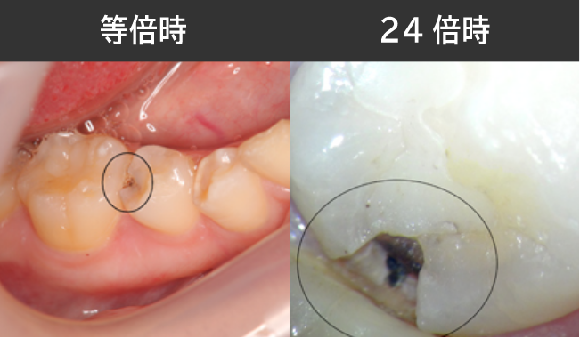 削る量を抑えた虫歯治療