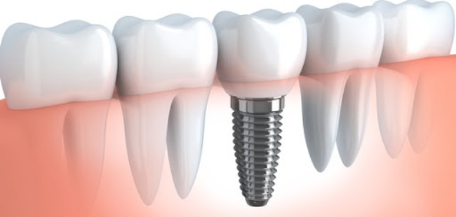 インプラント治療とは？