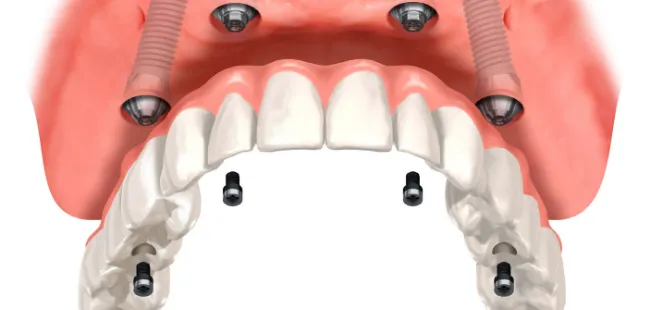 インプラント｜【香櫨園・打出・夙川・今津】むらまつ歯科