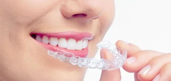 周りから見えないマウスピース矯正｜【香櫨園・打出・夙川・今津】むら