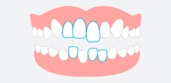 ガタガタの歯並び（叢生）