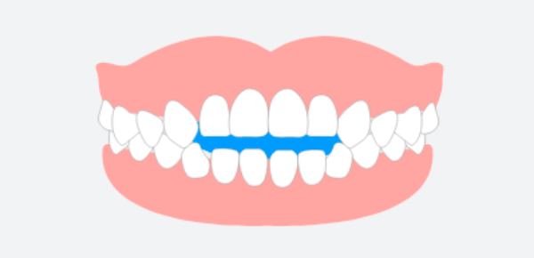 前歯が噛み合わない（開咬）