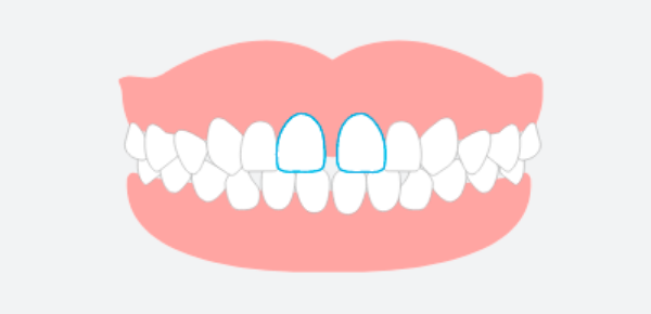 すきっ歯（空隙歯列）