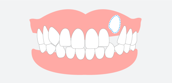 歯が足りない･生えてこない（先天性欠損・埋伏）