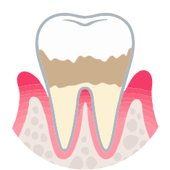 軽度歯周炎