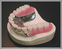 金属床義歯（部分義歯）