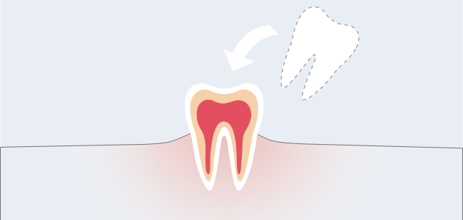 抜けた歯の再植