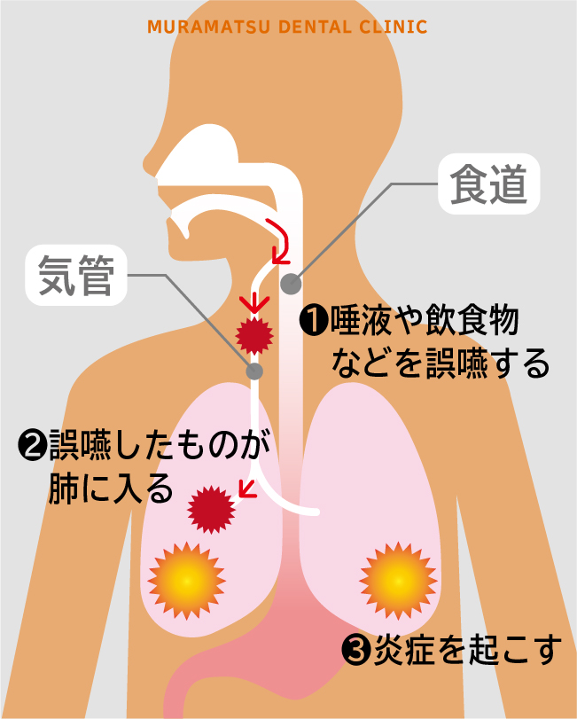 高齢者に多い「摂食・嚥下障害」について